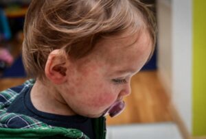 Rougeole: Ski Saint-Bruno et les Promenades seraient deux lieux d’exposition ciblés